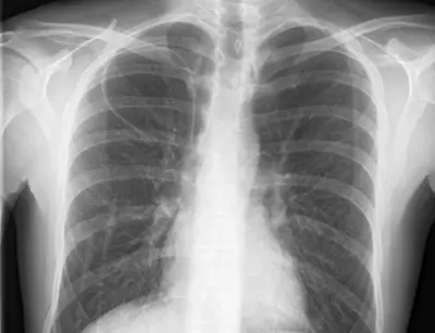 Radiograph from the case bank: Central venous catheter