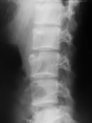 Radiograph from the case bank: Osteomyelitis