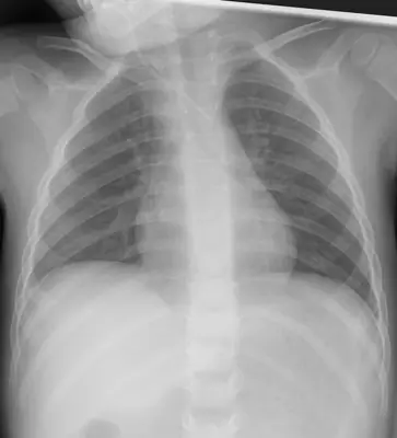 Radiograph from the case bank: Central venous catheter