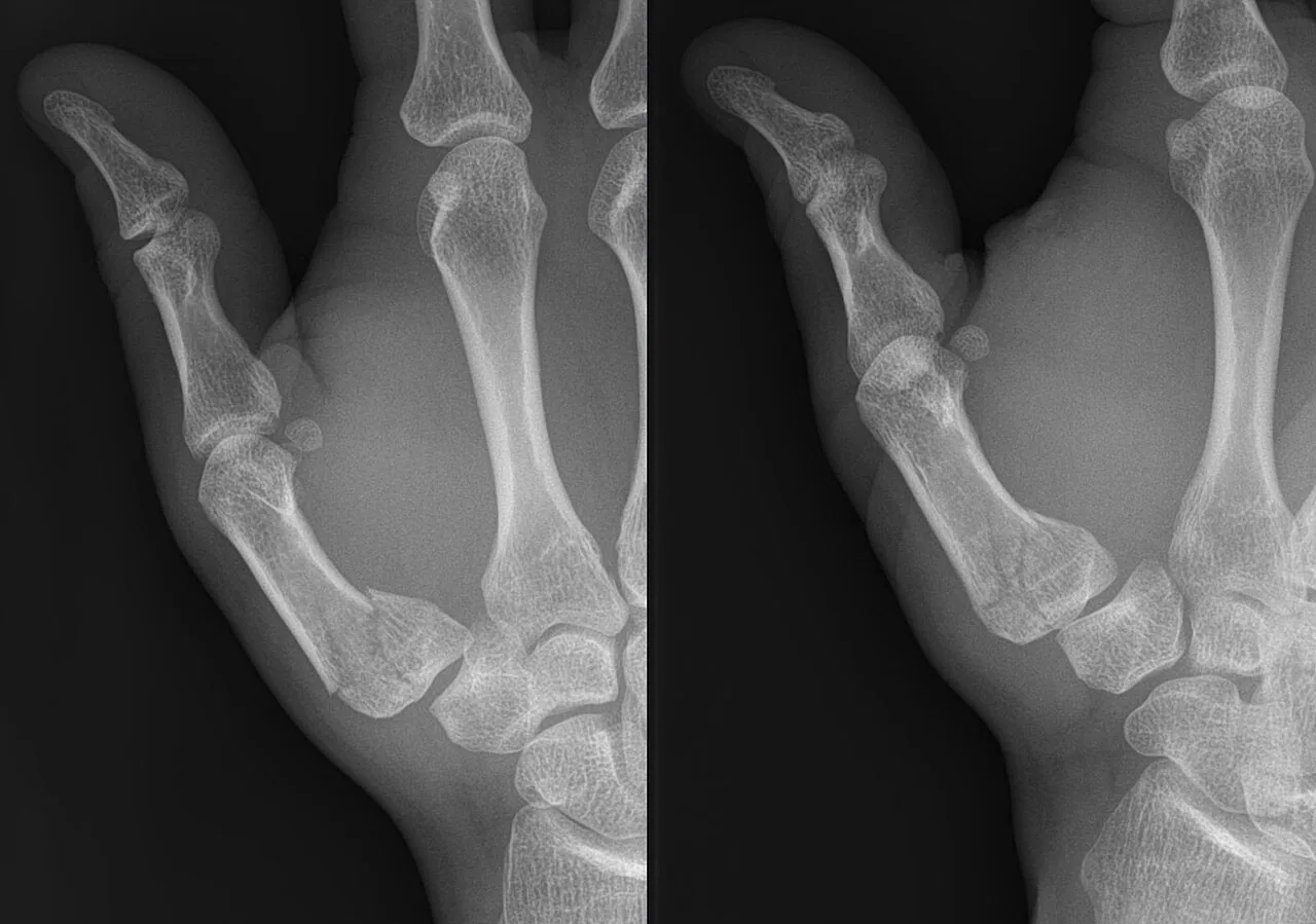 Upper limb radiograph for self-assessment