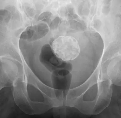 Radiograph from the case bank: Calcified uterine fibroid