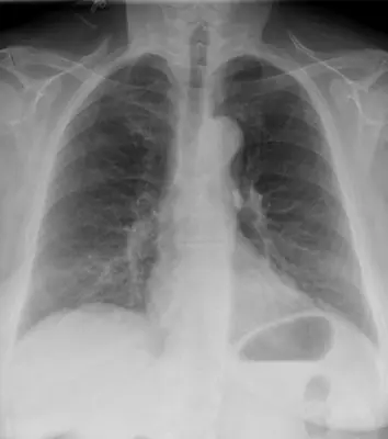 Radiograph from the case bank: Central venous catheter