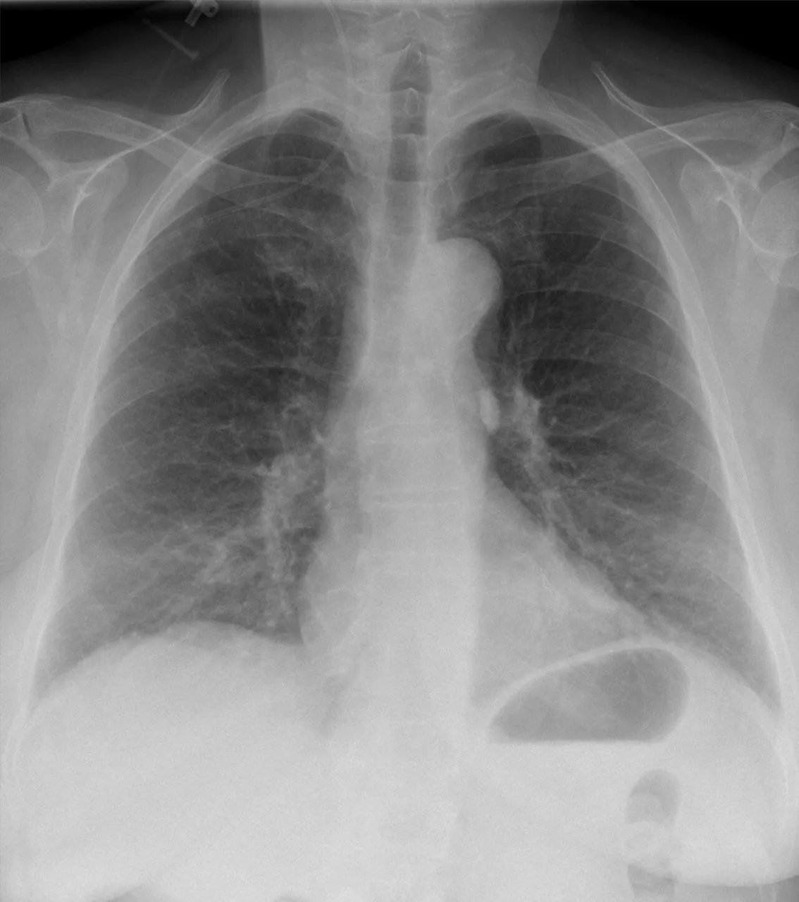 Lines & tubes radiograph for self-assessment
