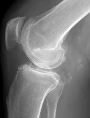 Radiograph from the case bank: Synovial chondromatosis