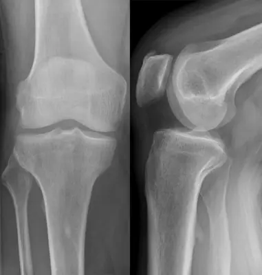 Radiograph from the case bank: Osteochondroma (exostosis)