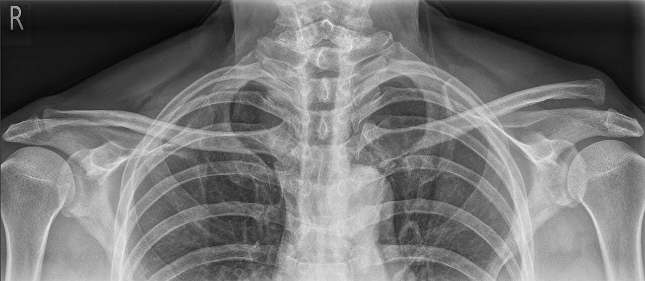 Upper limb radiograph for self-assessment