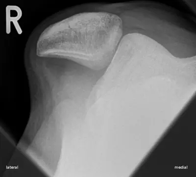 Radiograph from the case bank: Patellar dislocation