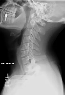 Radiograph from the case bank: Degenerative spondylosis