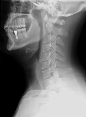 Radiograph from the case bank: Degenerative spondylosis