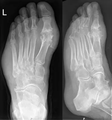 Radiograph from the case bank: Gout
