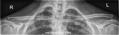 Radiograph from the case bank: Acromioclavicular joint dislocation
