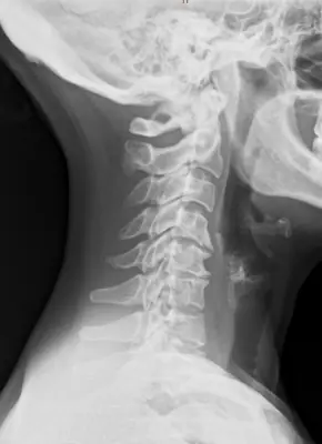 Radiograph from the case bank: Degenerative spondylosis