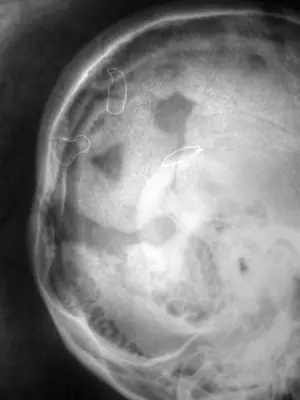 Radiograph from the case bank: Skull fracture