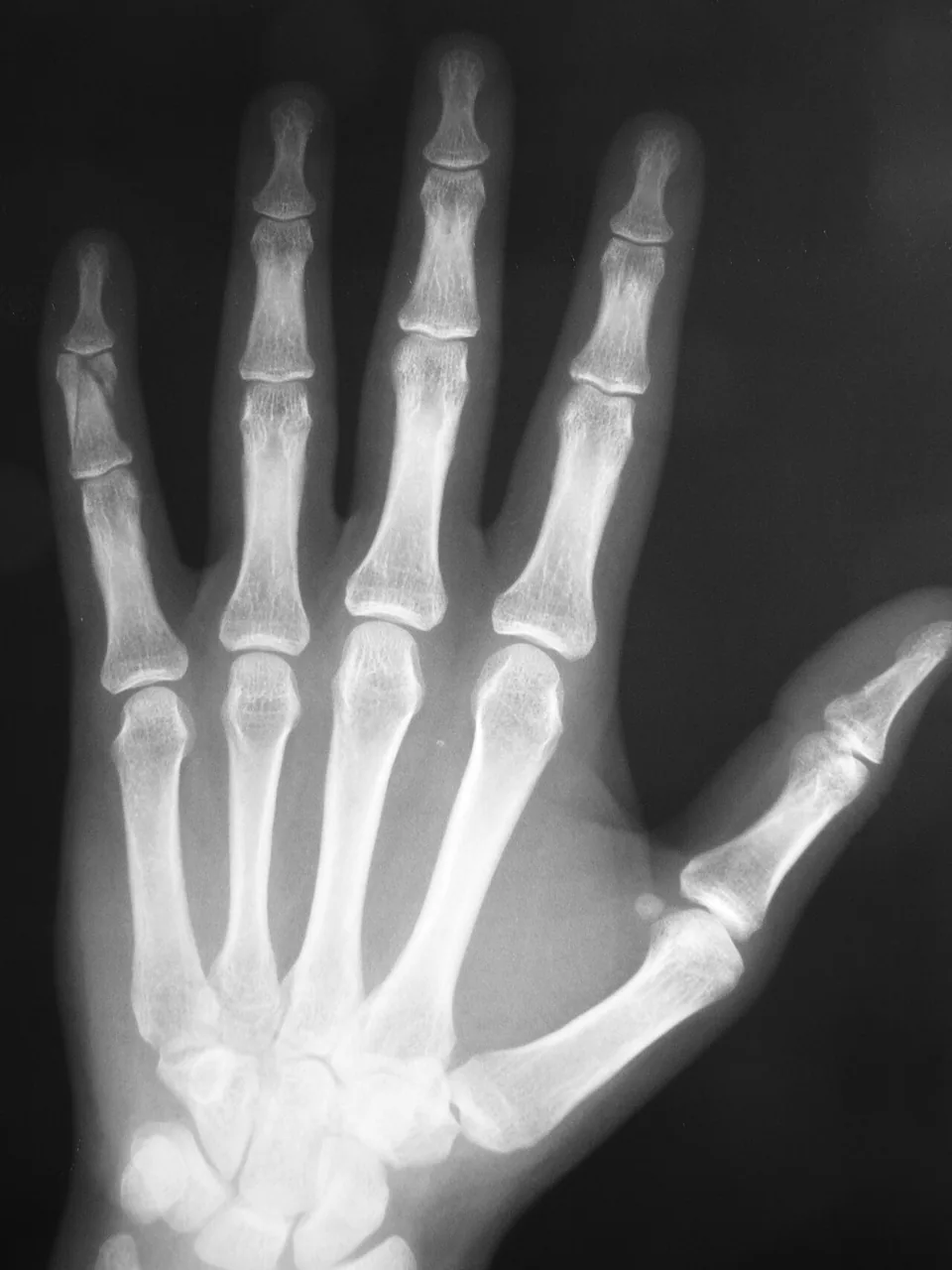 Upper limb radiograph for self-assessment