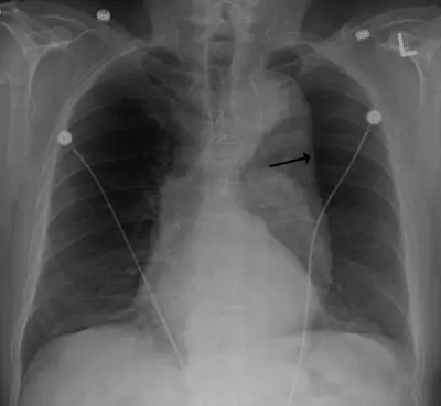 Radiograph from the case bank: Thoracic aortic aneurysm