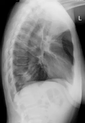 Radiograph from the case bank: Pneumonia (consolidation)