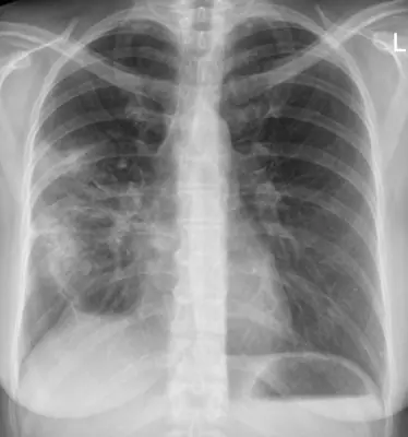 Radiograph from the case bank: Pneumonia (consolidation)