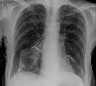 Radiograph from the case bank: Pneumothorax