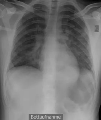 Radiograph from the case bank: Pulmonary oedema (heart failure)