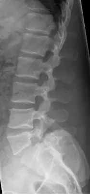 Radiograph from the case bank: Spondylolysis (pars defect)