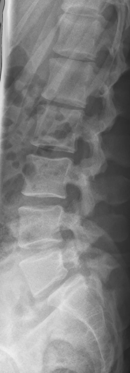 Spine radiograph for self-assessment