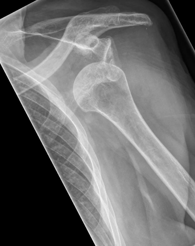 Upper limb radiograph for self-assessment