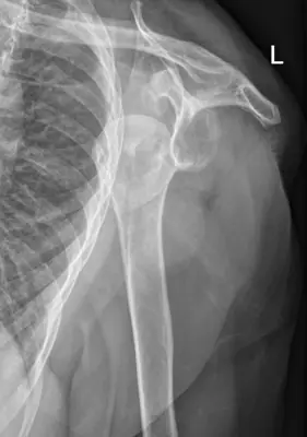 Radiograph from the case bank: Shoulder (glenohumeral) dislocation