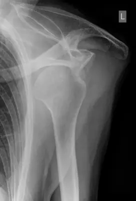 Radiograph from the case bank: Shoulder (glenohumeral) dislocation