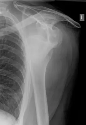 Radiograph from the case bank: Shoulder (glenohumeral) dislocation