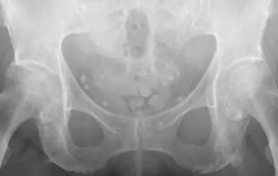 Radiograph from the case bank: Pelvic phleboliths