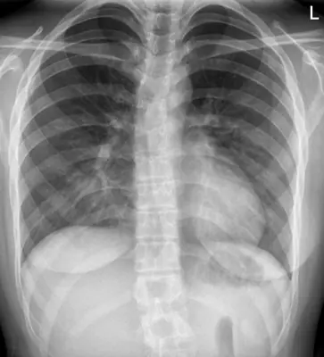 Radiograph from the case bank: Pectus excavatum