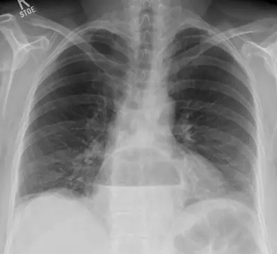 Radiograph from the case bank: Hiatus hernia