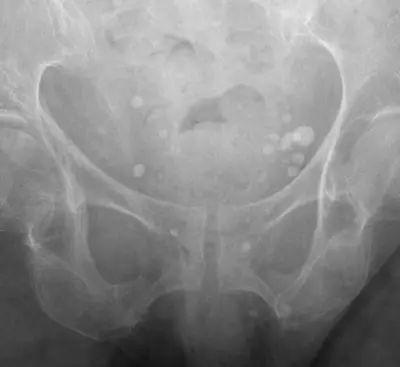 Radiograph from the case bank: Pelvic phleboliths