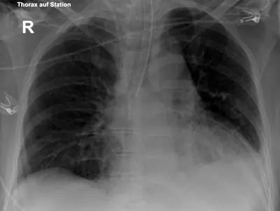 Radiograph from the case bank: Endotracheal tube