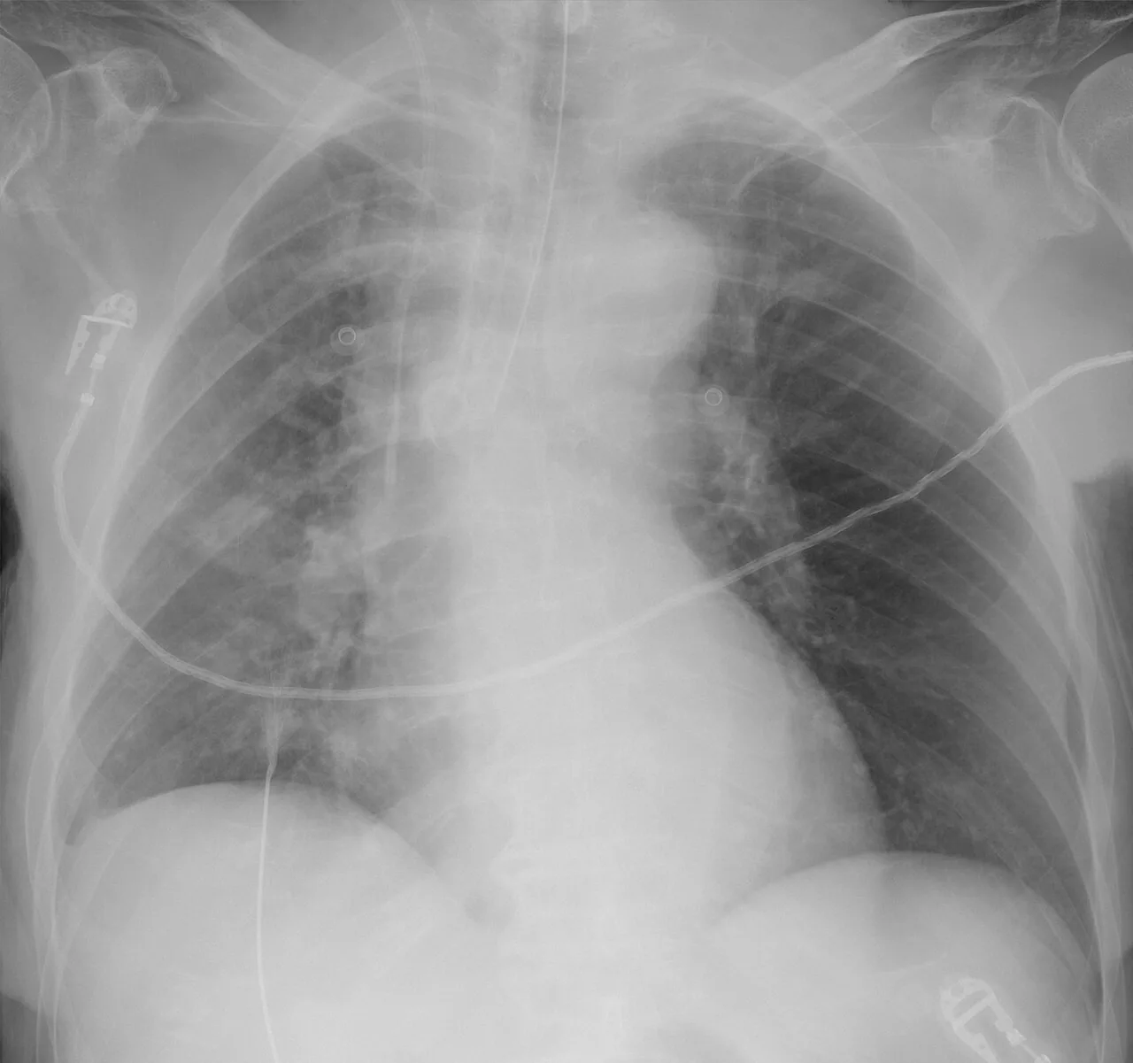 Lines & tubes radiograph for self-assessment