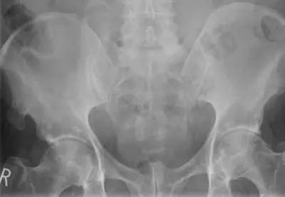 Radiograph from the case bank: Osteochondroma (exostosis)
