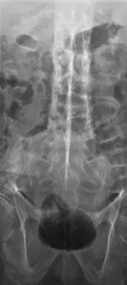 Radiograph from the case bank: Ankylosing spondylitis