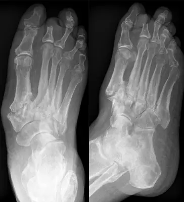 Radiograph from the case bank: Neuropathic (Charcot) arthropathy