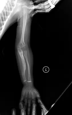 Radiograph from the case bank: Osteogenesis imperfecta