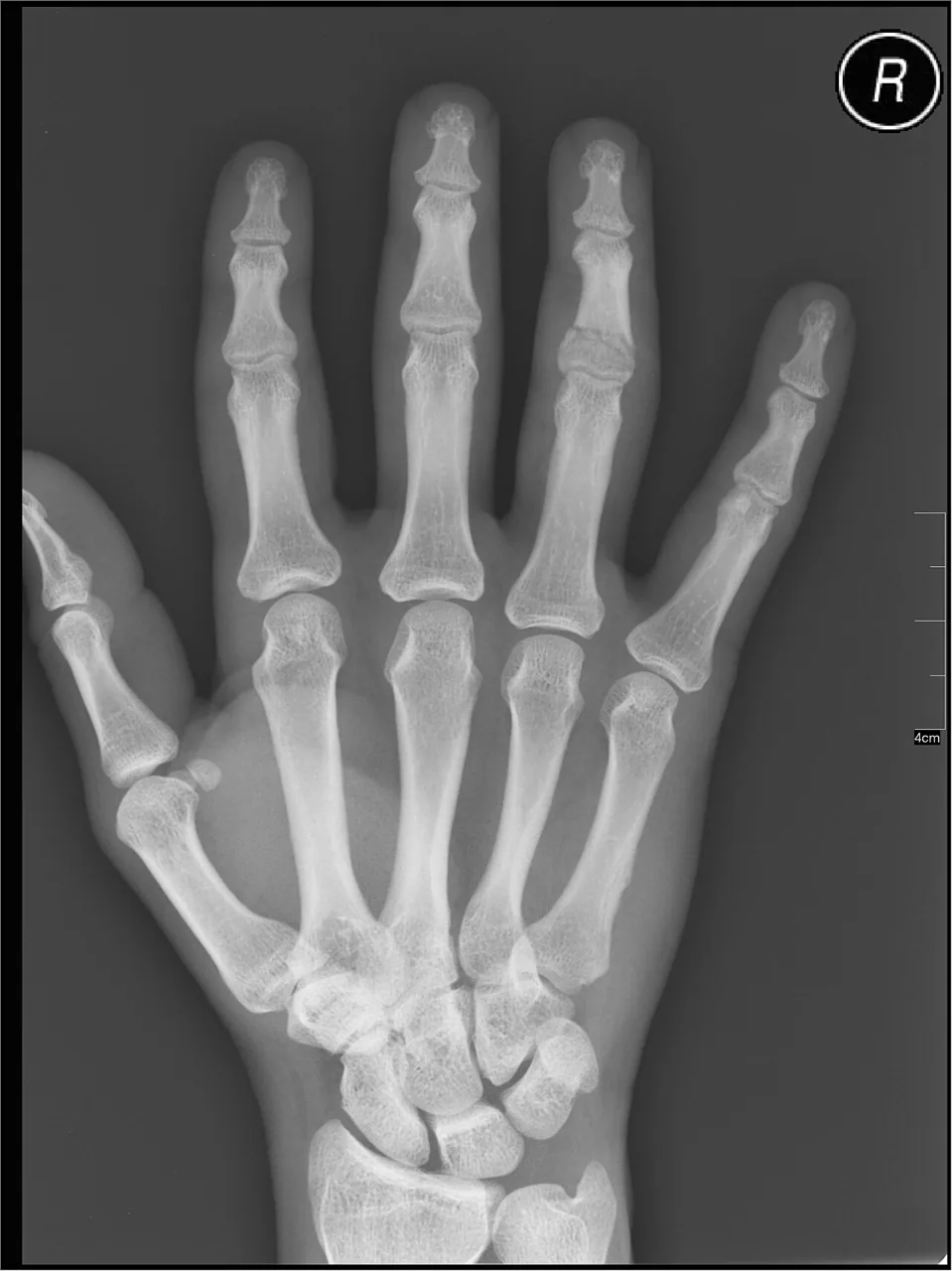 Upper limb radiograph for self-assessment