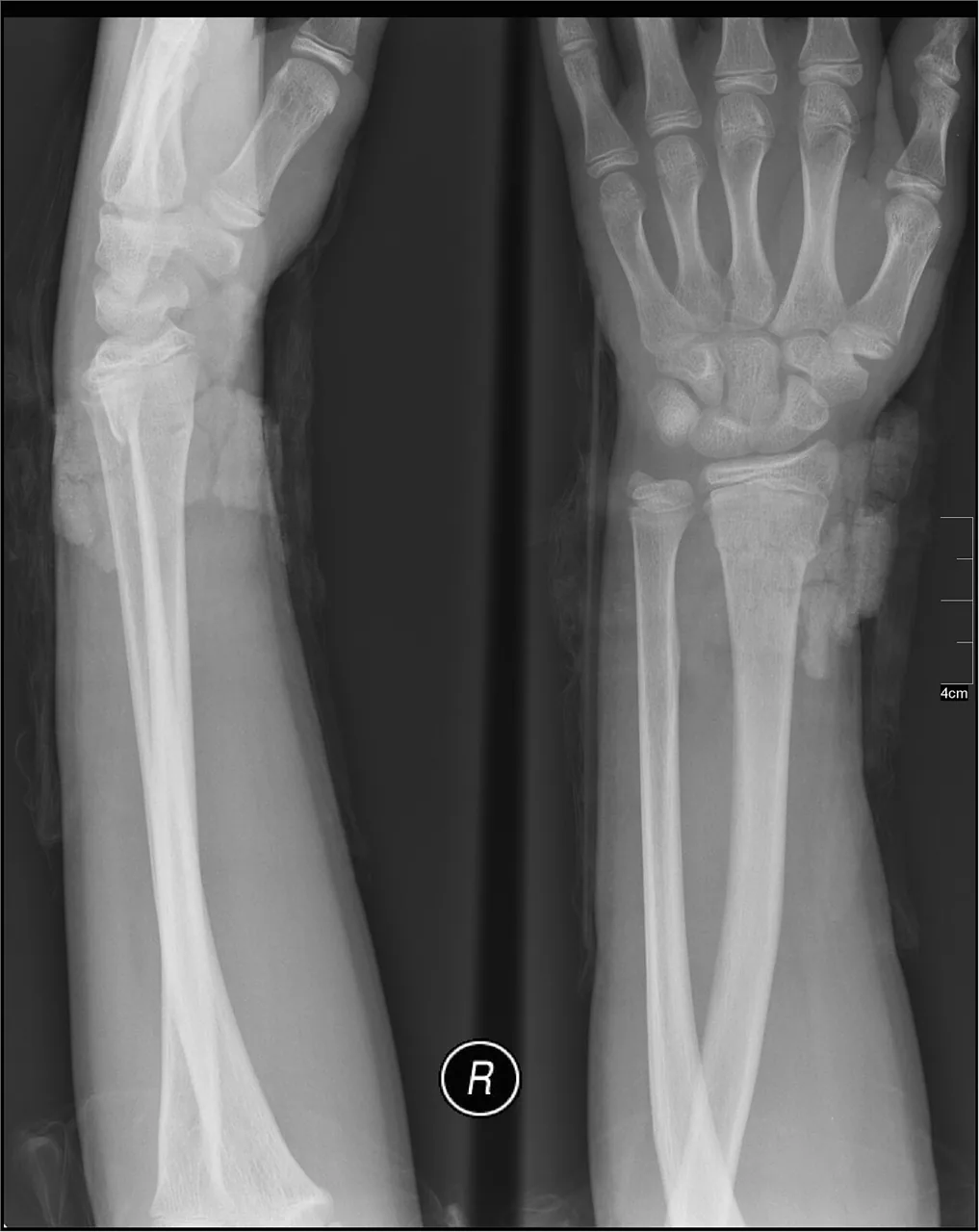 Upper limb radiograph for self-assessment