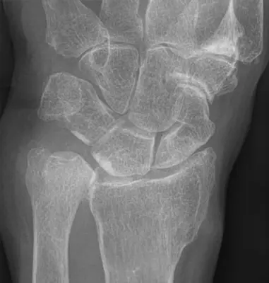 Radiograph from the case bank: Distal radius fracture