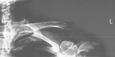 Radiograph from the case bank: Clavicle fracture