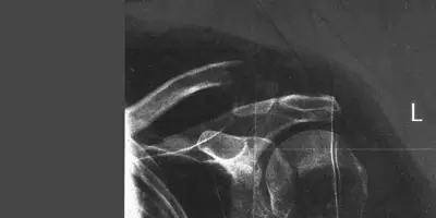Radiograph from the case bank: Clavicle fracture