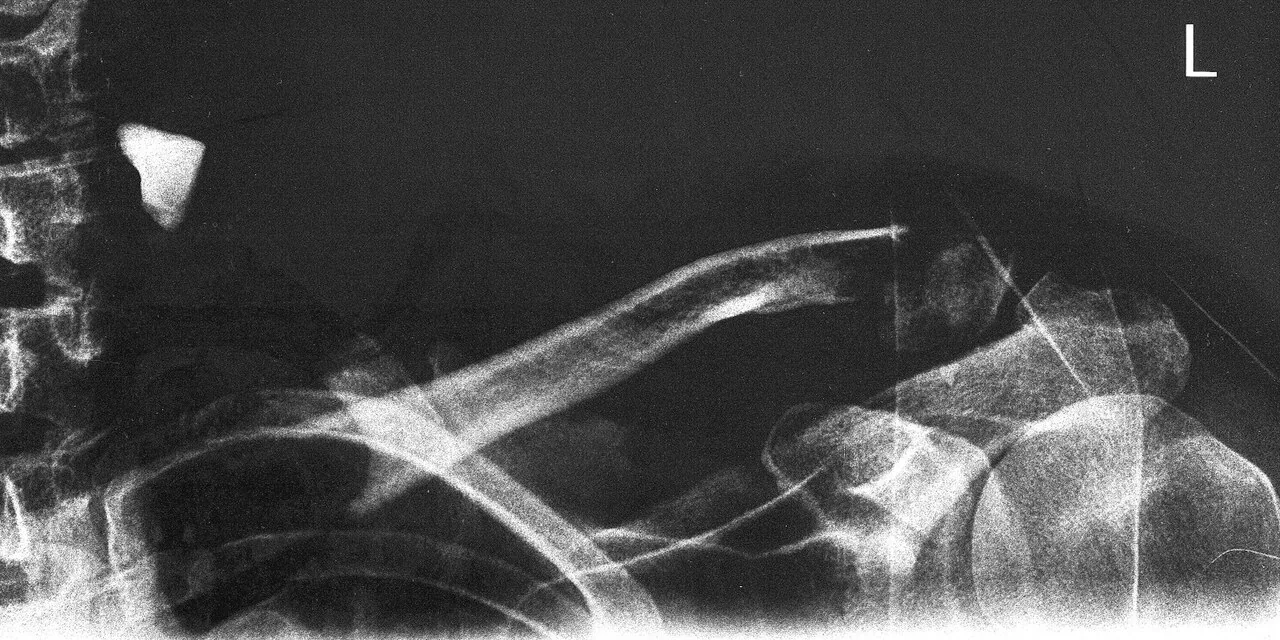 Upper limb radiograph for self-assessment