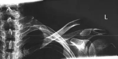 Radiograph from the case bank: Clavicle fracture