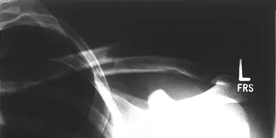 Radiograph from the case bank: Clavicle fracture