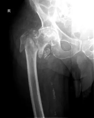 Radiograph from the case bank: Hip (proximal femoral) fracture