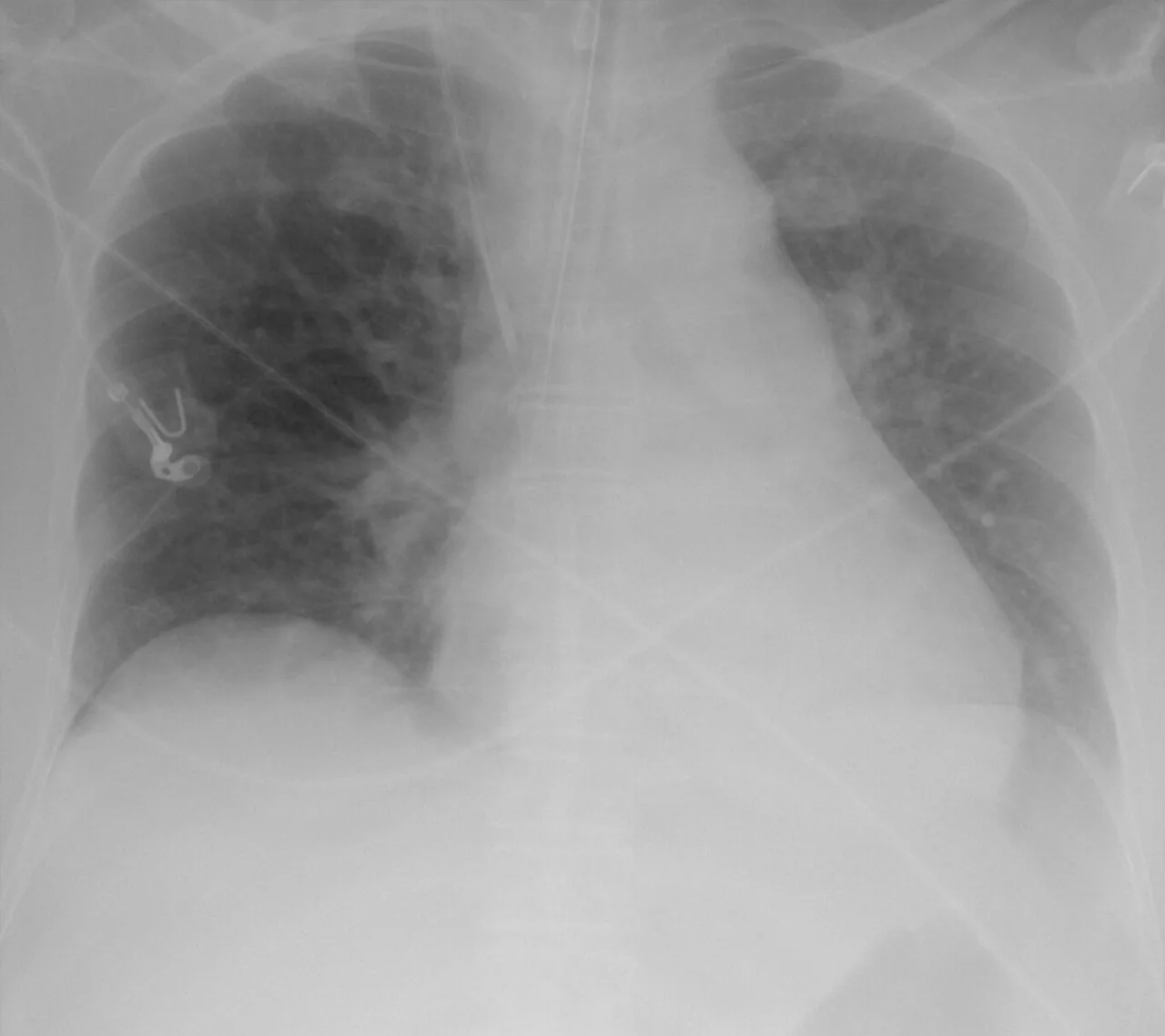 Lines & tubes radiograph for self-assessment