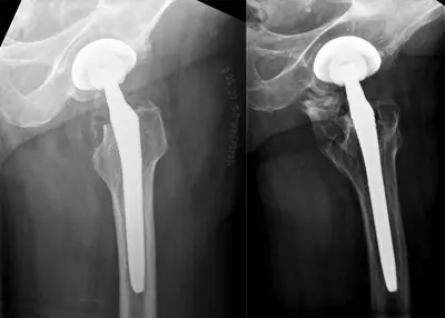 Radiograph from the case bank: Heterotopic ossification